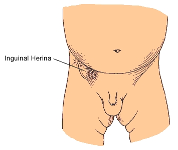 Inguinal hernia (male)