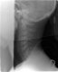Lateral Cervical Spine XR