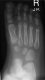 X-ray Right Foot