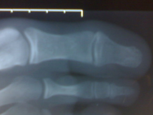 X-ray Right Great Toe