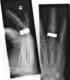 X-Ray ring finger