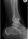 Lateral Left Ankle