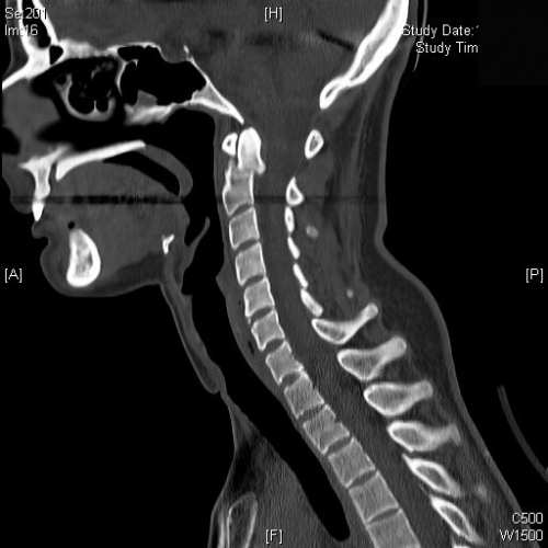 CT C Spine